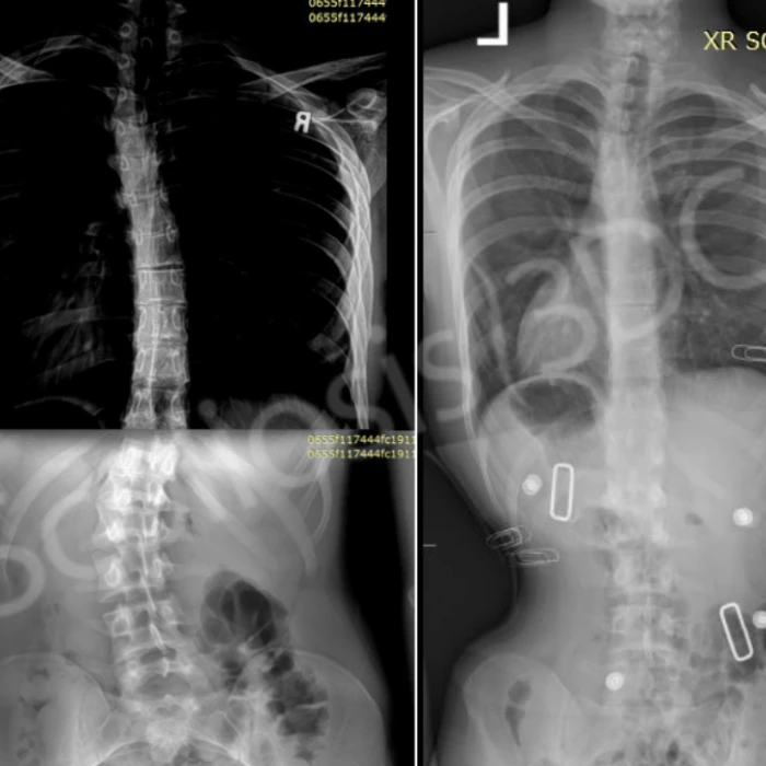 Two X-ray images of an adult male's torso display lumbar scoliosis, with one image showing the spinal curvature and the other showing the spine with a corrective brace and much less curvature.