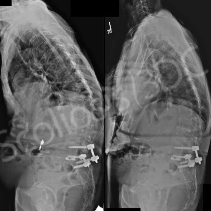 Two lateral X-rays of an elderly patient's torso showing a severe lumbar curve with spinal fusion hardware visible in the lower back compared to a less severe curve after brace wear.